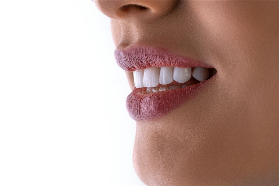 Close-up of a patient's smile showing a clear dental aligner